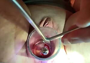 Dilating to 9mm w Tenaculum draw up with Hegar